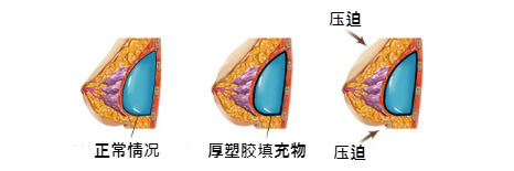 乳房修复术