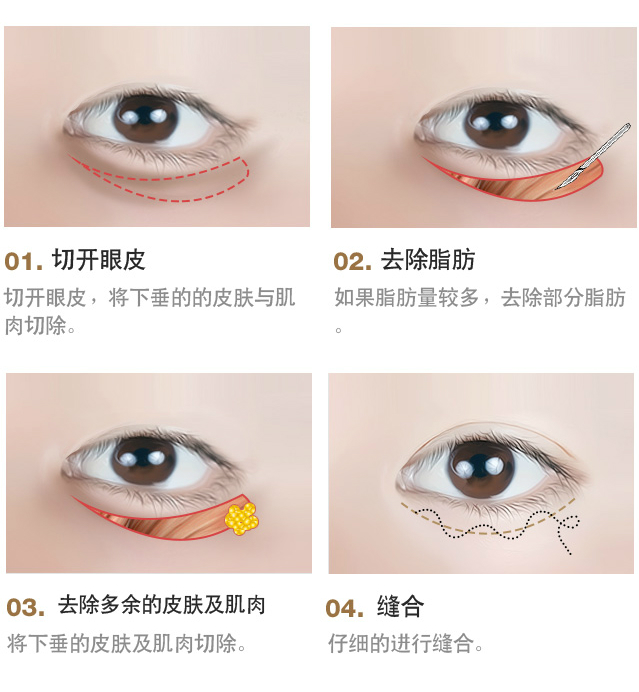 下眼睑